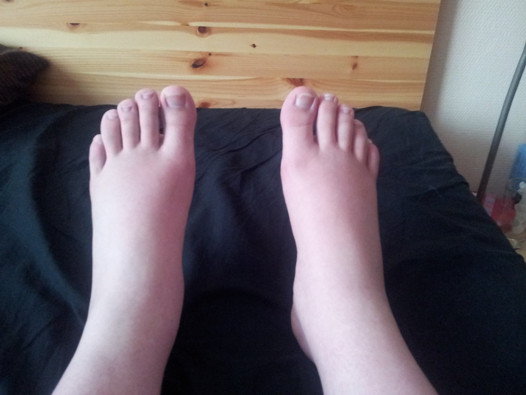 Swollen feet in pregnancy